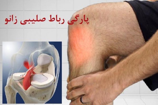 فیزیوتراپی رباط صلیبی 